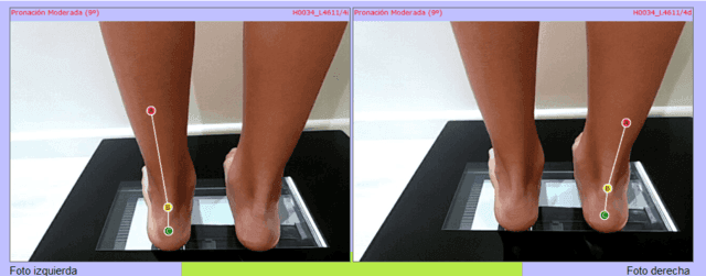 IPlantillas, pisada, orthopaedic insoles, walk, gait, posture, scanner 3D