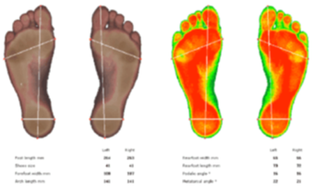 Plantillas, pisada, orthopaedic insoles, walk, gait, posture, scanner 3D