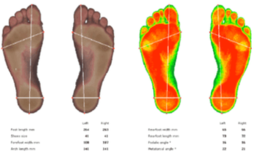 Plantillas, pisada, orthopaedic insoles, walk, gait, posture, scanner 3D